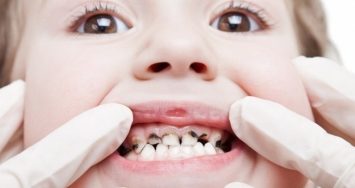 Top 10 Cách chữa sâu răng đơn giản và triệt để nhất
