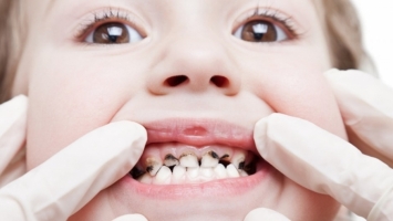 Top 10 Cách chữa sâu răng đơn giản và triệt để nhất